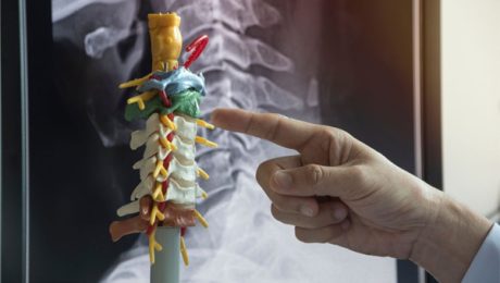 Spondilolizis ve Spondilolistezis nedir
